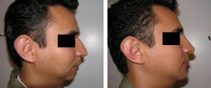 15 Minute Nose Job
